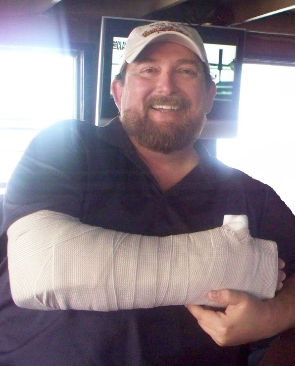 Me in my temporary splint the day after the accident