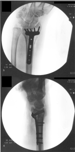 Xray of mywrist after surgery